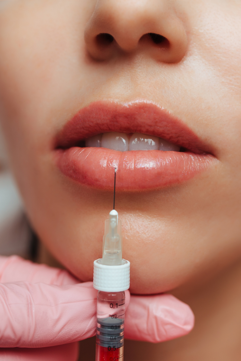 first-time-lip-fillers